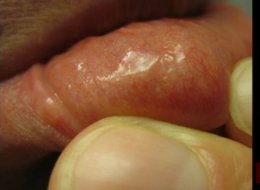 Jonathan D. Allen found a worm that crawled into his cheek.