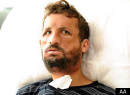 Before and after: Ugur Acar with his new face