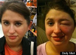 Nikki Perez almost went blind and lost part of her ear because of a brown recluse bite late last year.
