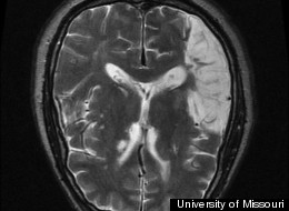 This neuroradiological scan shows what an injured right parietal lobe looks like. Individuals with similar injuries to this part of the brain will be less focused on the self, and more likely to be able to experience spiritual connection with a higher power/nature, depending on their faith tradition.