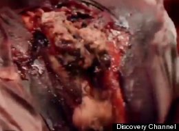 In the early 1800s, Army surgeon William Beaumont turned fur trapper Alexis St. Martin into a live organ donor and did lots of experiments on his stomach, which had a hole in it.