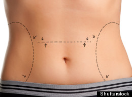 More and more millennials are going under the knife. A look at the rise of plastic surgery in Generation Y (Shutterstock)