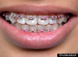 Fake braces, which come in many colors and designs, have been blamed in the deaths of two Thai teenagers.