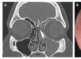 Dental Implant Ends Up In Woman's Sinus; X-Ray Photo Will Give You A ...